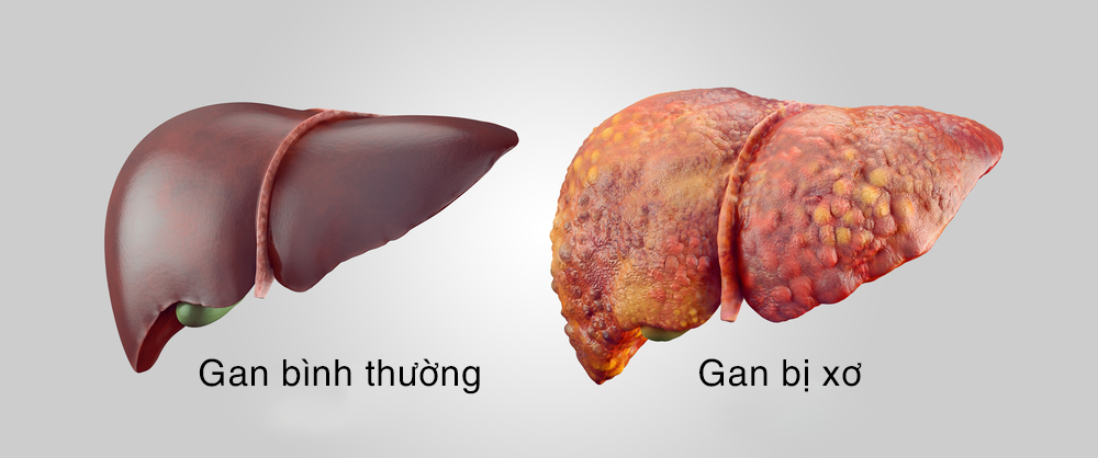 Bệnh xơ gan có chữa được không?