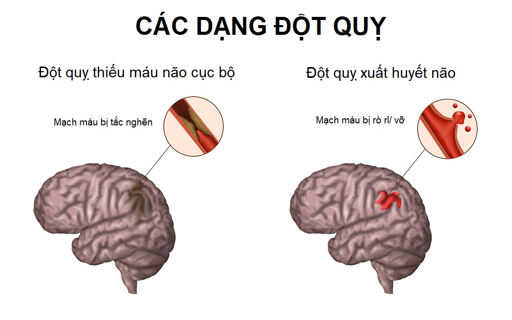 Đột quỵ có 2 dạng: đột quỵ nhồi máu não và đột quỵ xuất huyết não