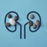 Sỏi thận hình thành thế nào? Các nguyên nhân gây sỏi thận thường gặp