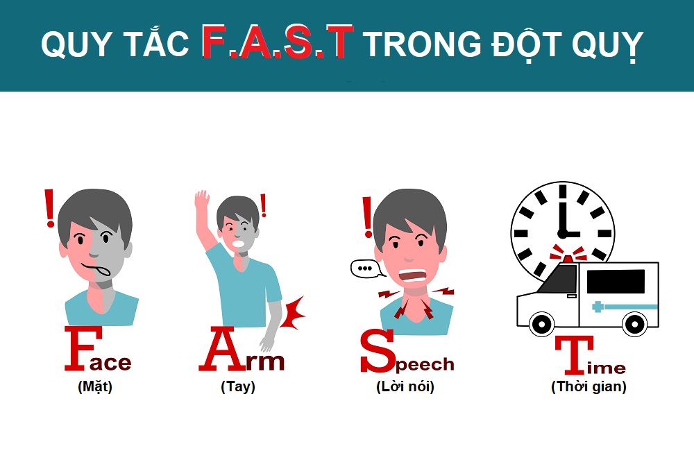 Nhận biết dấu hiệu đột quỵ bằng quy tắc F.A.S.T