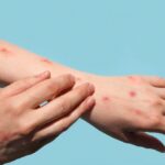 Những thông tin cần biết về bệnh đậu mùa khỉ