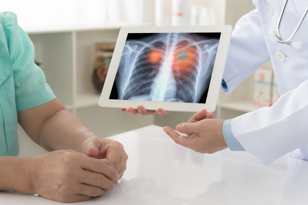 8 dấu hiệu ung thư phổi sớm mà bạn cần đặc biệt chú ý