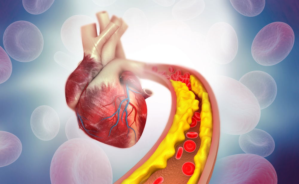 Nguyên nhân gây nhồi máu cơ tim là gì?