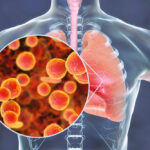 Tìm hiểu các thông tin về bệnh viêm phổi