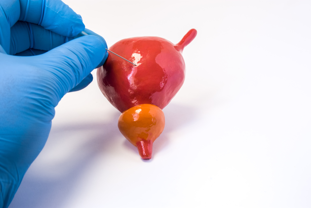 Chẩn đoán ung thư bàng quang