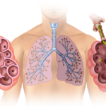 Khí phế thũng: Bệnh phổi mạn tính bạn chớ xem thường