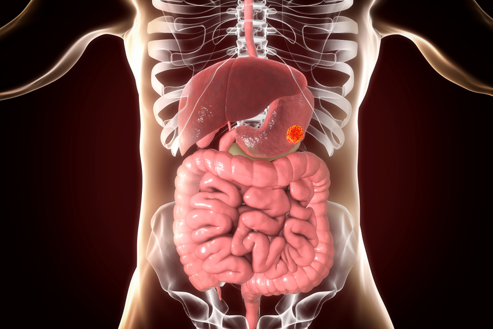 Nguyên nhân ung thư dạ dày