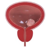 Những điều cần biết về ung thư bàng quang