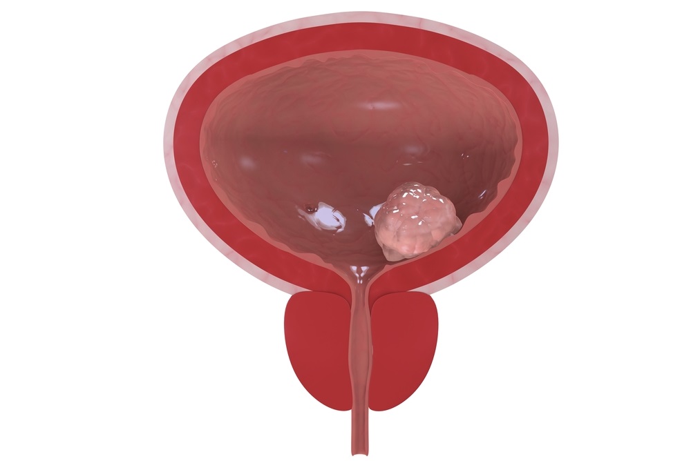 Những điều cần biết về ung thư bàng quang