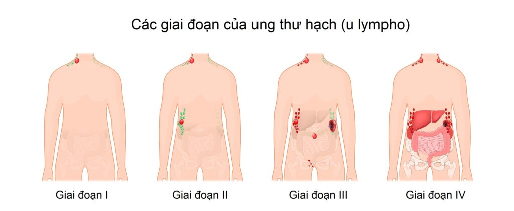 Các giai đoạn của bệnh ung thư hạch (u lympho)