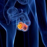 Ung thư tinh hoàn - căn bệnh nguy hiểm của 