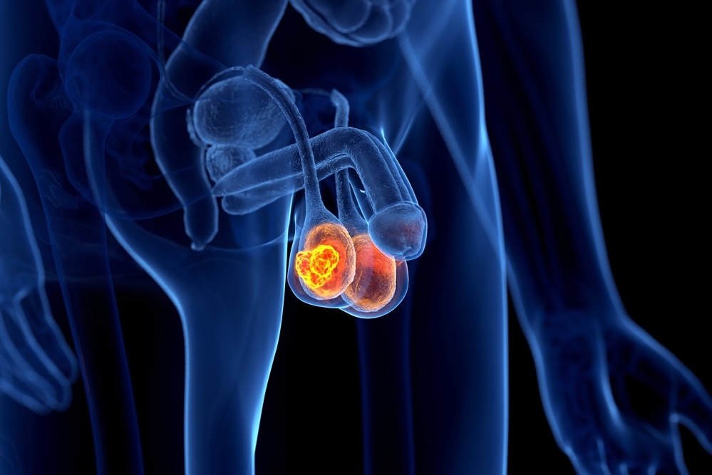 Ung thư tinh hoàn - căn bệnh nguy hiểm của 