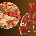 Lao phổi và những điều bạn cần biết