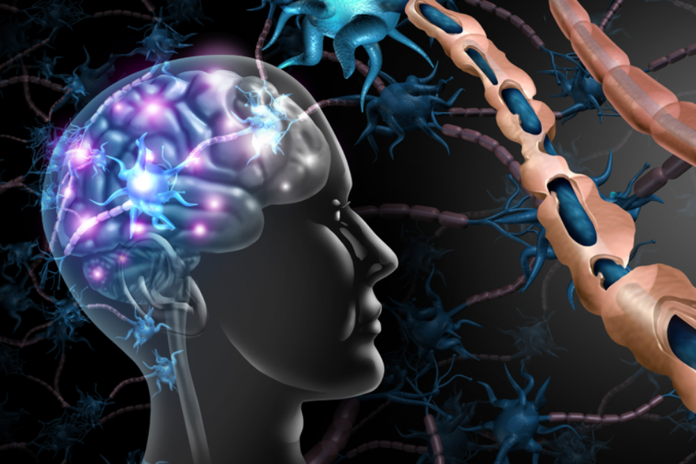 Nguyên nhân bệnh đa xơ cứng và các yếu tố nguy cơ