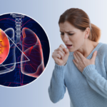 Triệu chứng viêm phổi theo nguyên nhân và đối tượng