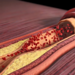 Triệu chứng xơ vữa động mạch theo từng vị trí