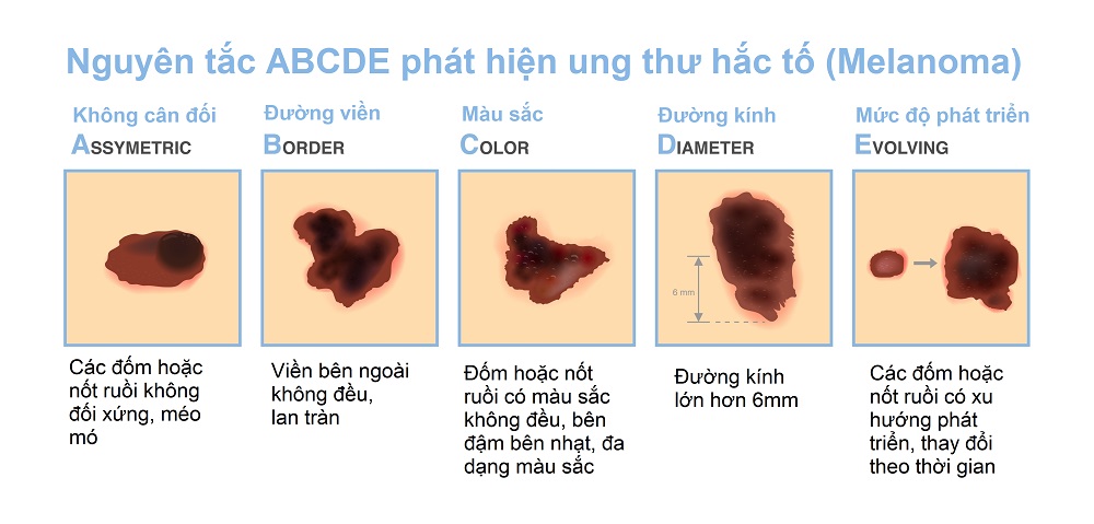 Dấu hiệu ung thư da hắc tố