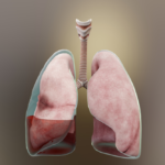 Tràn dịch màng phổi: Tình trạng nguy hiểm chớ nên xem thường