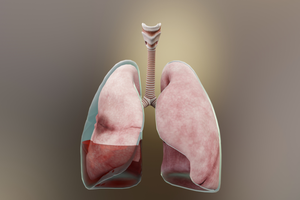 Tràn dịch màng phổi: Tình trạng nguy hiểm chớ nên xem thường