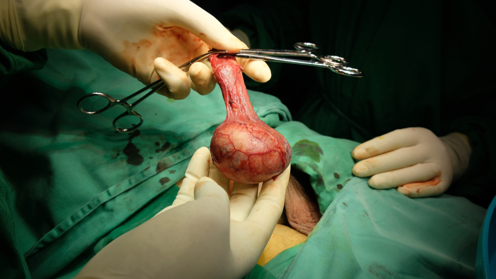 Ung thư tinh hoàn có chữa được không và phương pháp điều trị phẫu thuật