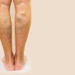 Suy giãn tĩnh mạch chân (Suy giãn tĩnh mạch chi dưới)