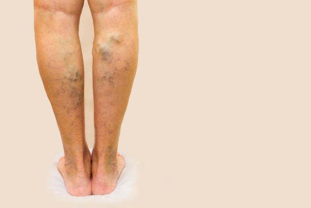 Suy giãn tĩnh mạch chân (Suy giãn tĩnh mạch chi dưới)