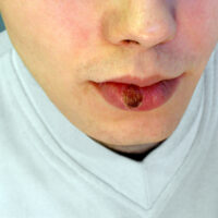 Nhận biết sớm bệnh giang mai giai đoạn 1 qua các săng giang mai