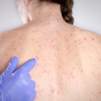 Bệnh giang mai là gì? Dấu hiệu, phòng ngừa và cách điều trị