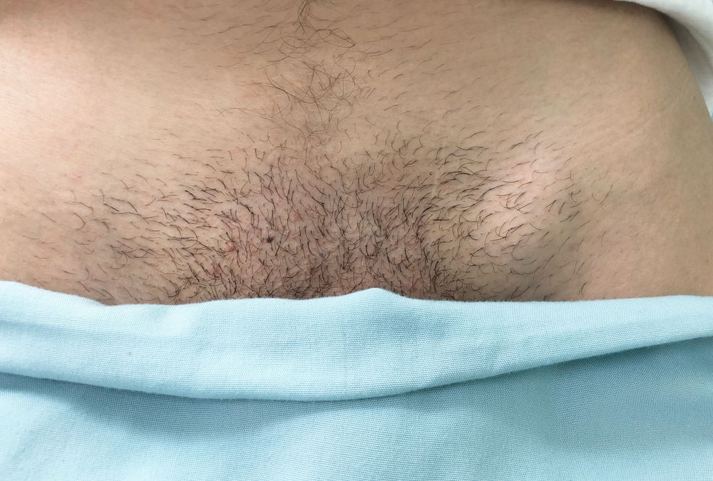 Dấu hiệu, triệu chứng của bệnh giang mai giai đoạn 1