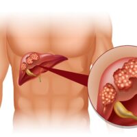 Ung thư gan giai đoạn cuối có chữa được không?