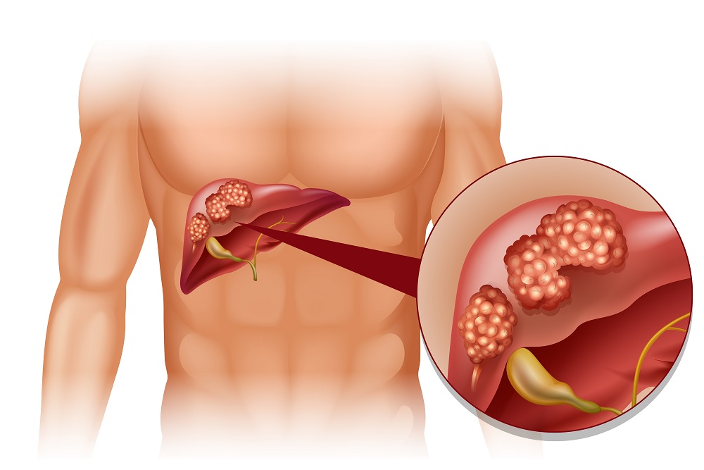 Ung thư gan giai đoạn cuối có chữa được không?