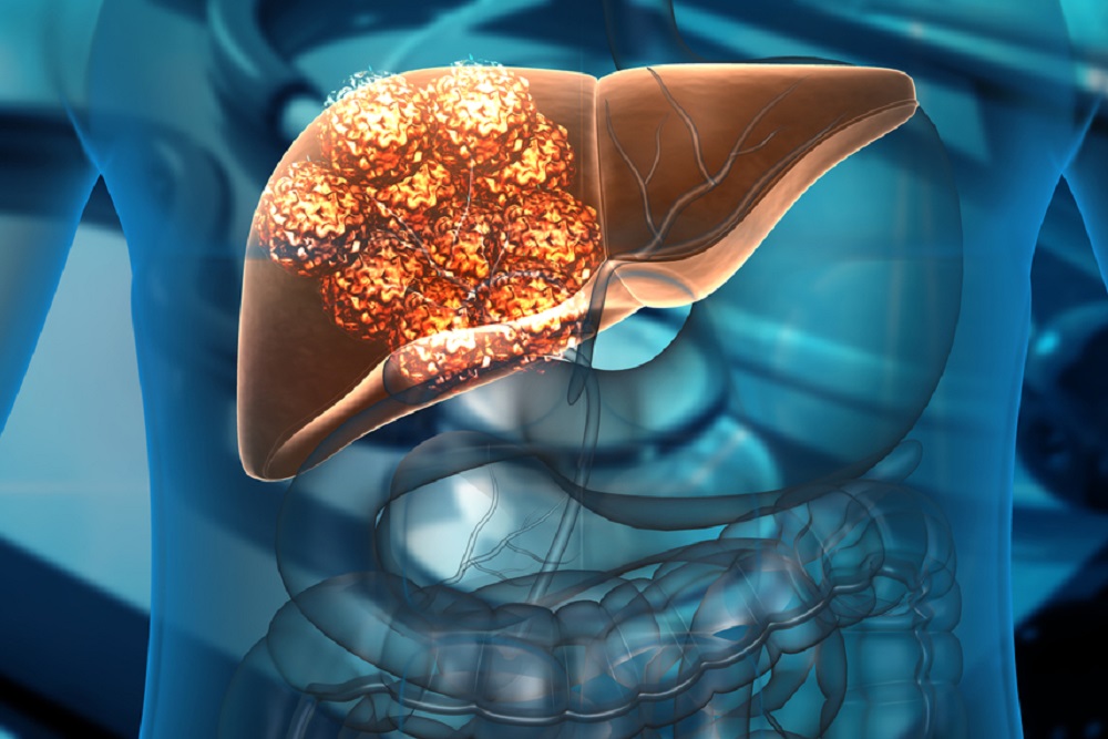 Ung thư gan nguyên phát: Hiểu đúng để điều trị hiệu quả