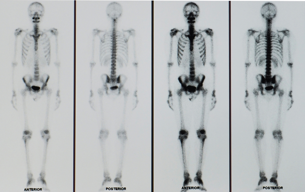 Ung thư vòm họng di căn xương