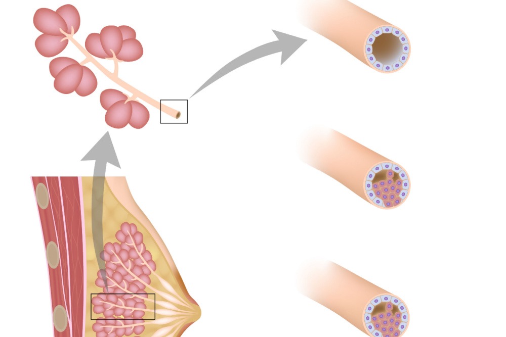 Các loại ung thư vú theo giải phẫu bệnh