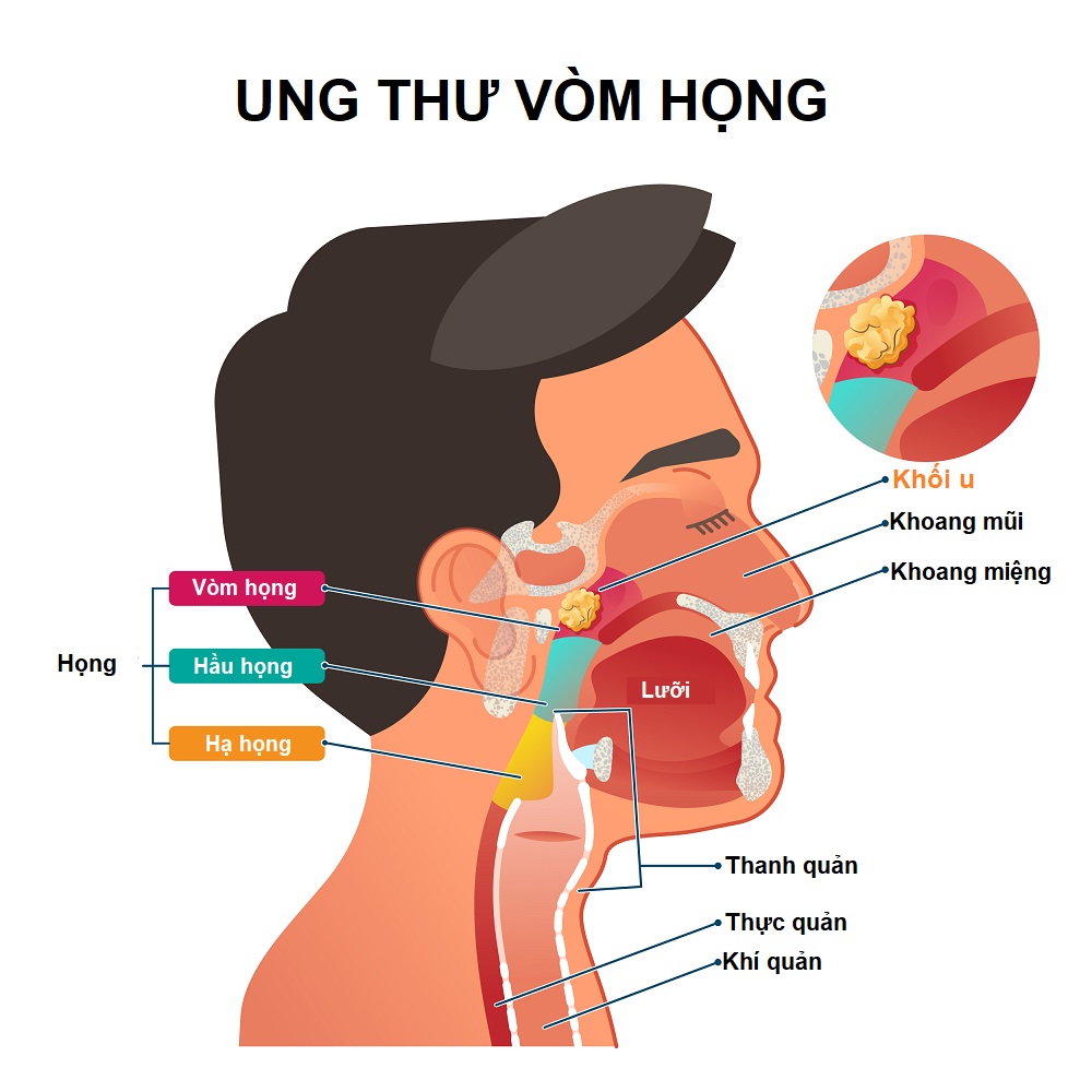 Ung thư vòm họng giai đoạn 3 là gì?