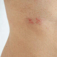 Bệnh giời leo có lây cho người khác không? Làm sao phòng ngừa?