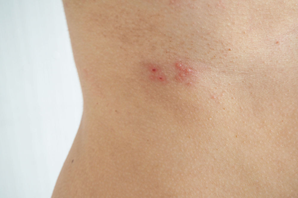 Bệnh giời leo có lây cho người khác không? Làm sao phòng ngừa?