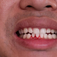 Bệnh nhân sốt xuất huyết bị chảy máu chân răng có nguy hiểm không?