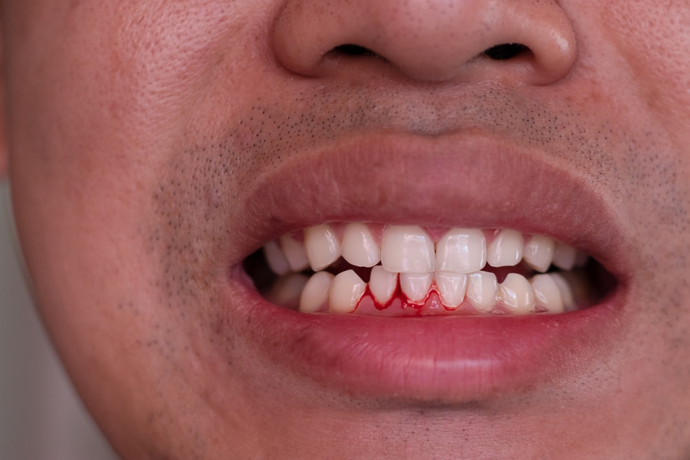 Bệnh nhân sốt xuất huyết bị chảy máu chân răng có nguy hiểm không?