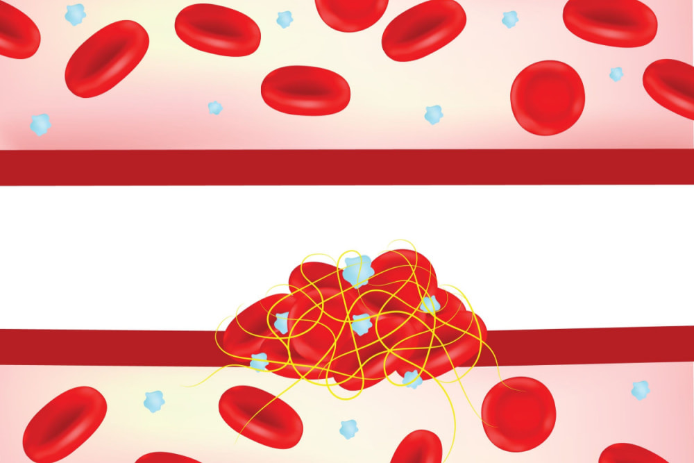 Nguyên nhân sốt xuất huyết chảy máu cam